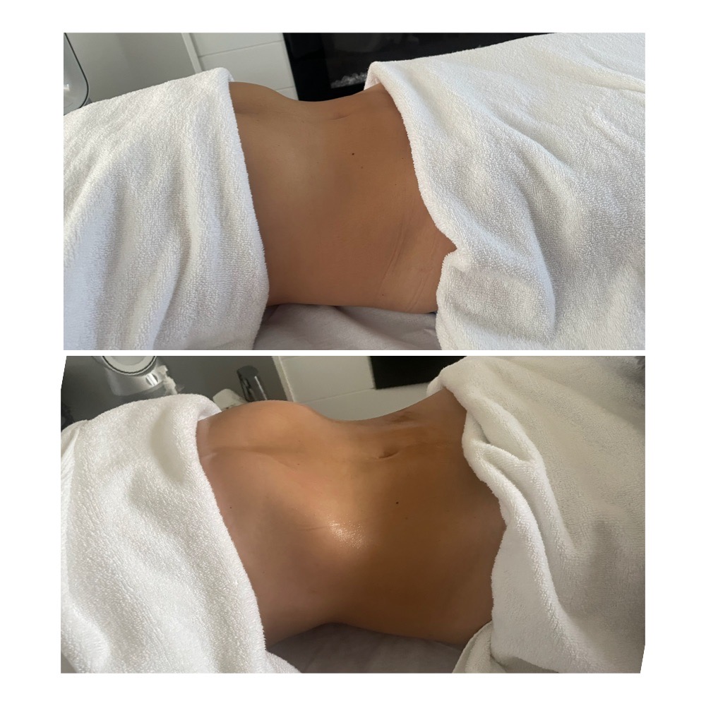 Brazilian Lymphatic Drainage results