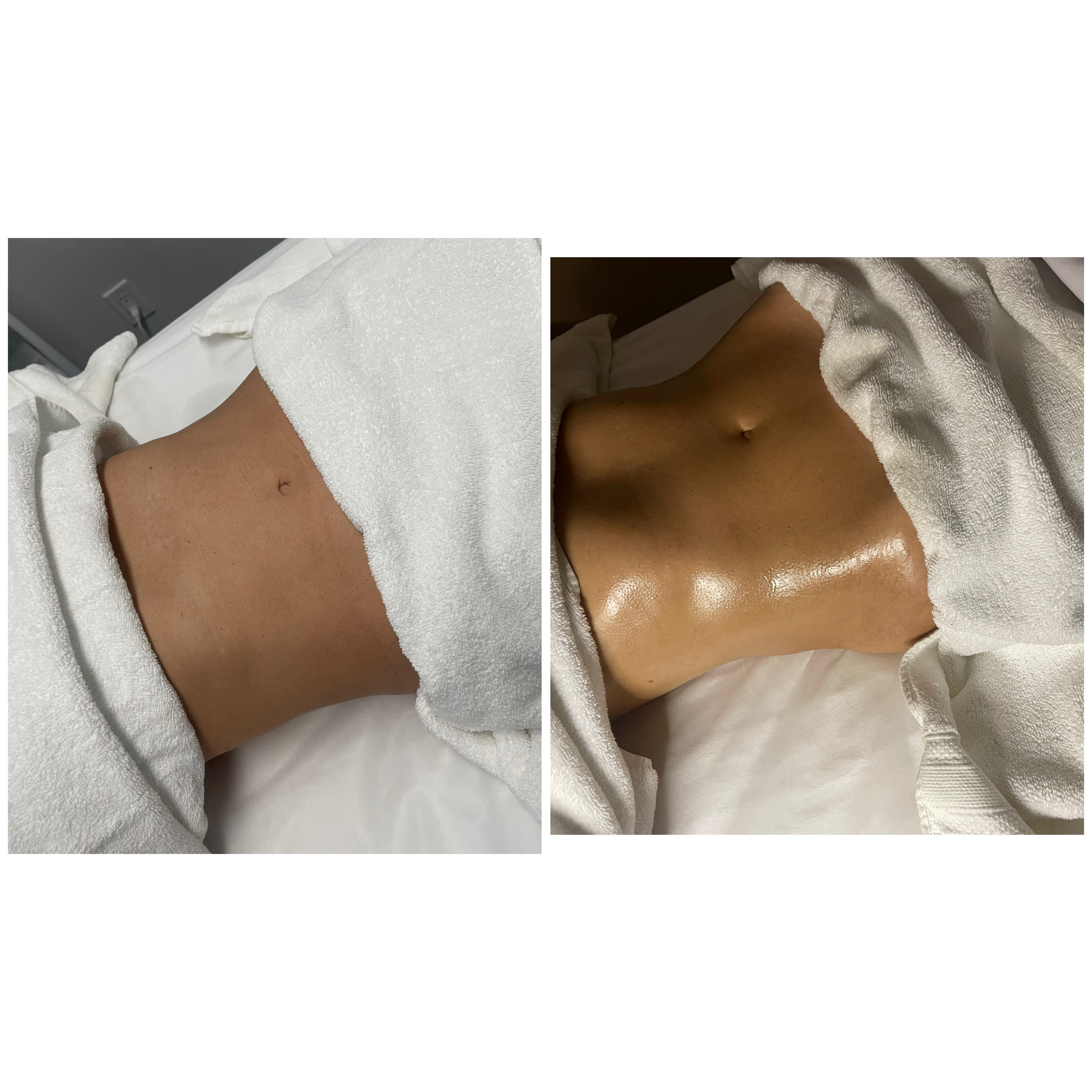 Body contouring results