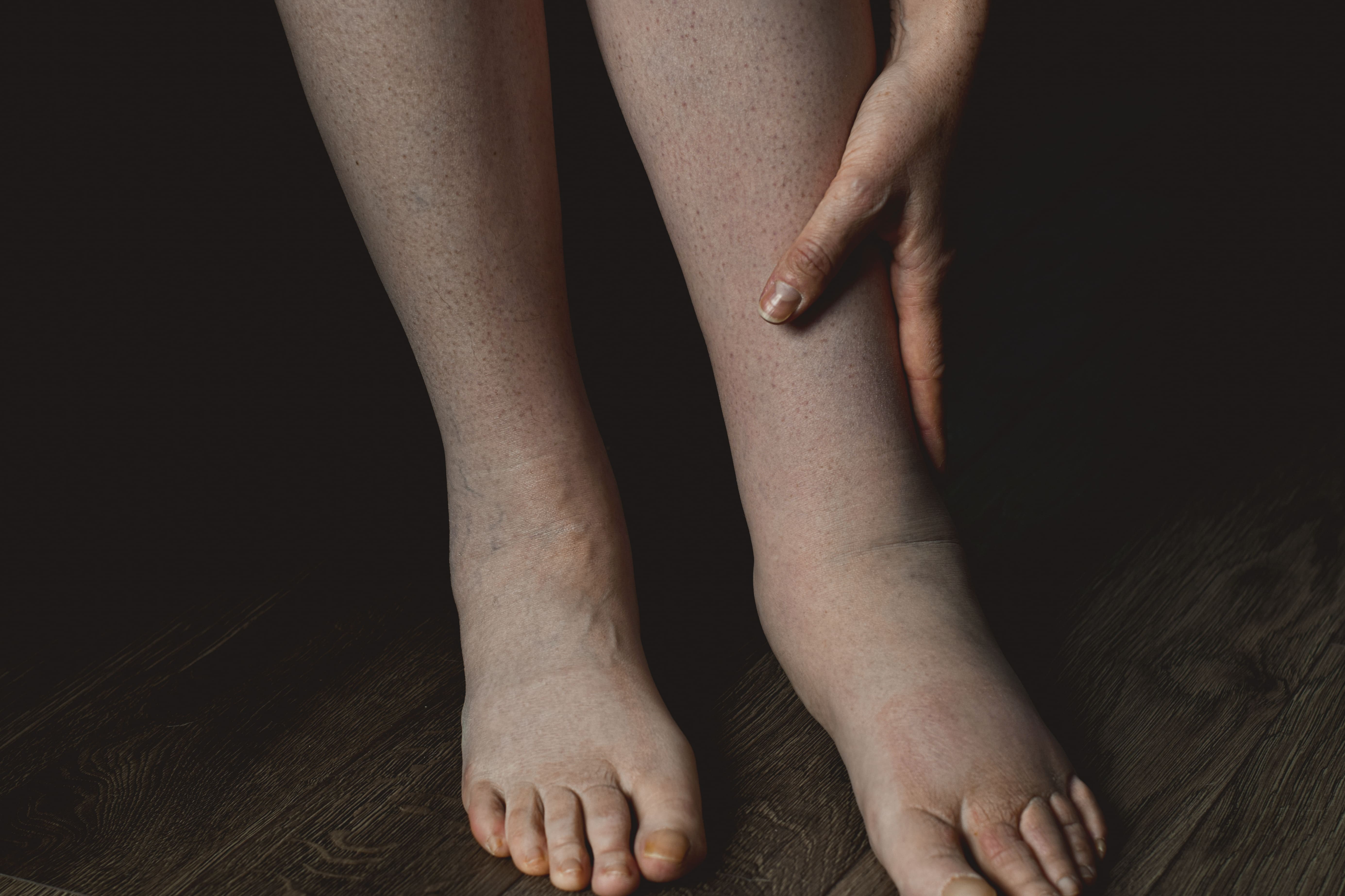 jambes enflées seniors