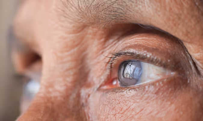 Cataracte personnes âgées