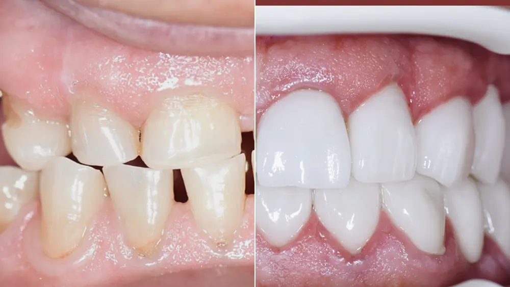 Тотальна реабілітація: комбінований кейс на зубах та імплантатах