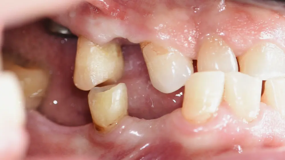 Тотальна реабілітація: комбінований кейс на зубах та імплантатах