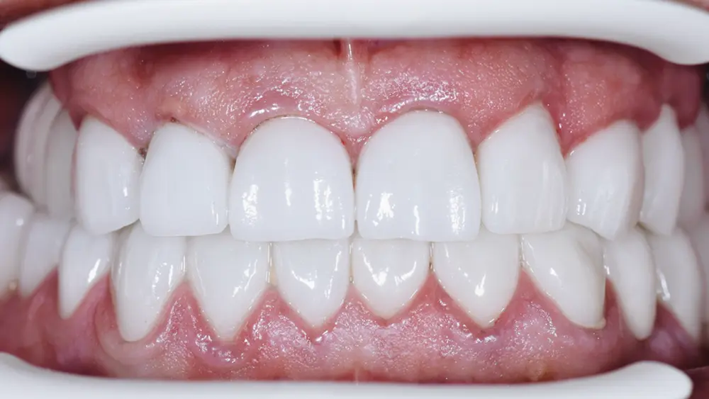 Тотальна реабілітація: комбінований кейс на зубах та імплантатах