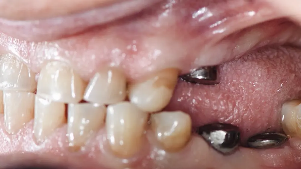 Тотальна реабілітація: комбінований кейс на зубах та імплантатах