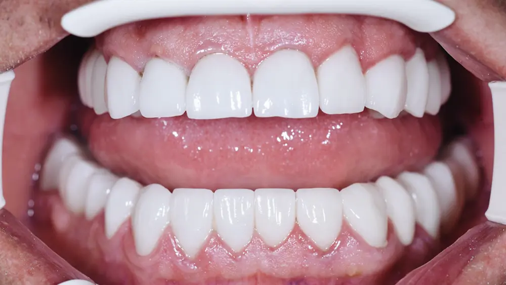 Тотальна реабілітація: комбінований кейс на зубах та імплантатах