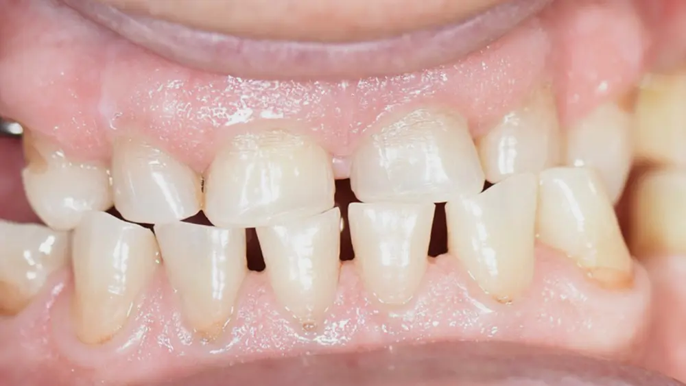 Тотальна реабілітація: комбінований кейс на зубах та імплантатах