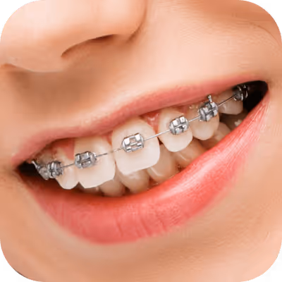 Sonrisa con brackets