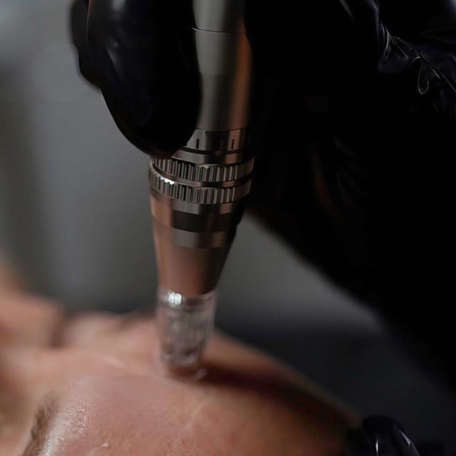 If you’re looking for smoother skin texture, softer acne scars, smaller-looking pores, a brighter complexion, and reduced fine lines, microneedling can help refresh and revitalise your skin. By stimulating your skin’s natural production of collagen and elastin, this treatment supports long-term anti-ageing benefits—meaning your skin continues to improve over time. ✨