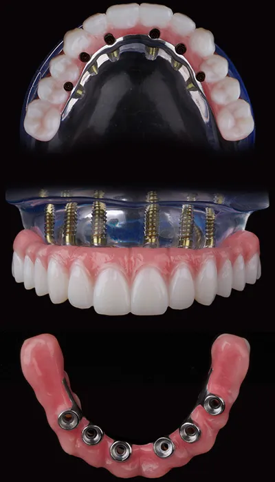 Hybridge Gen 5 Full-Arch Prosthesis