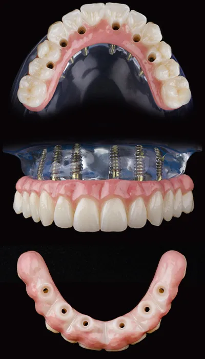 Hybridge MZ Full-Arch Prosthesis