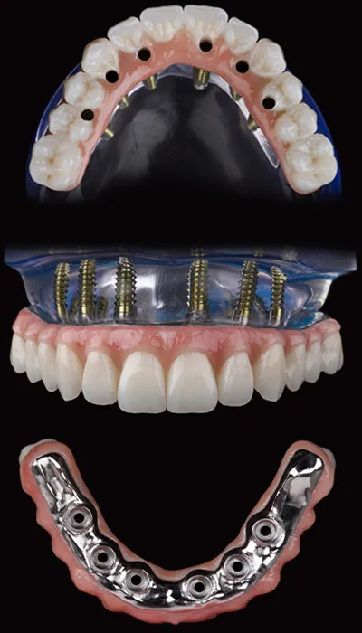Hybridge Prime Z Full-Arch Prosthesis