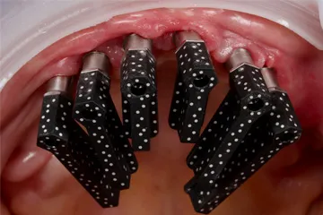 Close-up of a dental implant guide attached to upper gums showing black guide tubes with white dots.