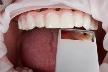 Close-up of a mouth with teeth and tongue, dental mirror reflecting part of the tongue.