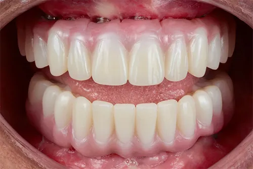 Close-up of upper and lower full dentures in an open mouth showing artificial teeth and gums.
