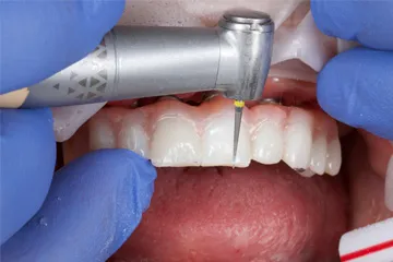 Dentist wearing blue gloves using a dental drill on a patient's upper front teeth.