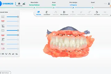 3D dental scan showing upper and lower teeth with surrounding gums in a dental software interface.