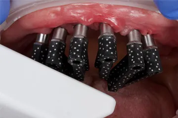Close-up of a dental procedure showing multiple dental implant abutments in the upper jaw.