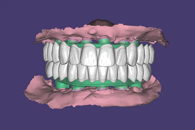 3D dental model showing upper and lower teeth with gums in pink and green overlays on purple background.