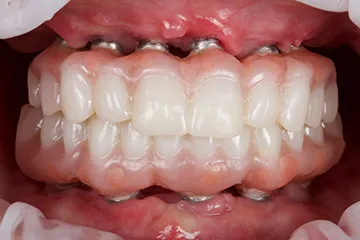 Close-up of full-arch fitted in mouth with visible metal dental implants under gums.