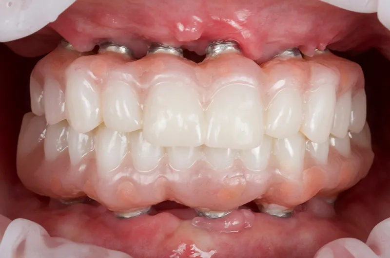 Close-up of full-arch fitted in mouth with visible metal dental implants under gums.