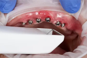 Close-up of dental implants in upper gums with dental tool and gloved hands visible.