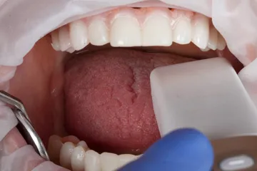 Close-up of a dental exam showing open mouth, teeth, tongue, and dental tools with a gloved hand.