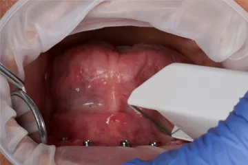Close-up of dental implant surgery inside open mouth with gloved hand using surgical tool.