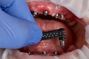 Gloved hand using a dental tool inside a mouth with multiple dental implants visible.
