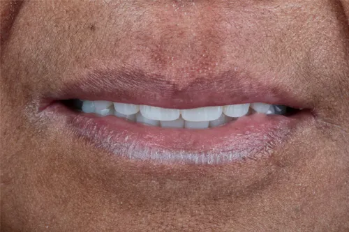 Close-up of a person's mouth with slightly parted lips showing white teeth.