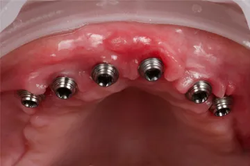 Close-up of upper gum with six dental implants embedded in pink tissue.