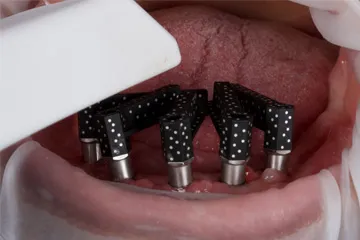 Dental impression copings with black and white polka dot covers inserted in lower gum for implant fitting.