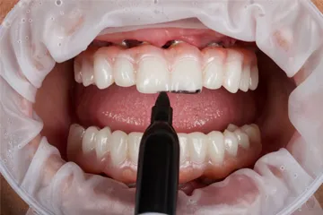 Close-up of open mouth showing teeth with dental tool coloring a tooth.