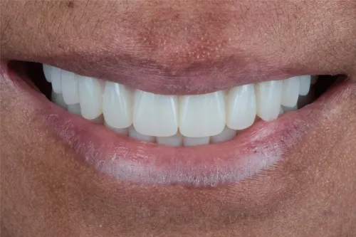 Close-up of a smiling mouth with white, evenly aligned teeth and brown lips.