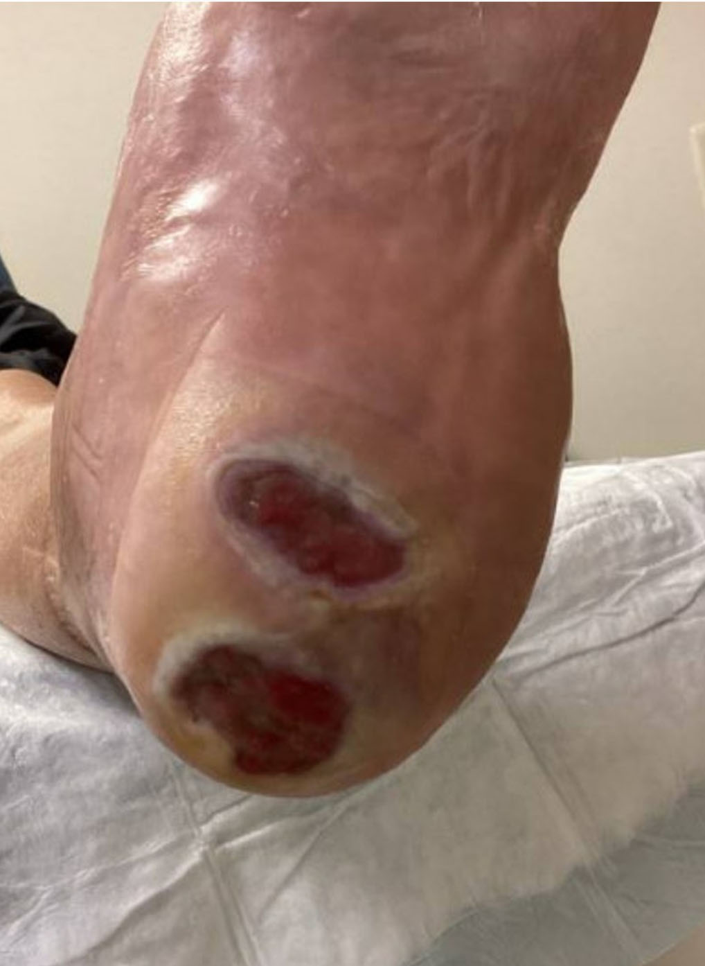 Arterial Wound during UrgoClean Ag treatment -4