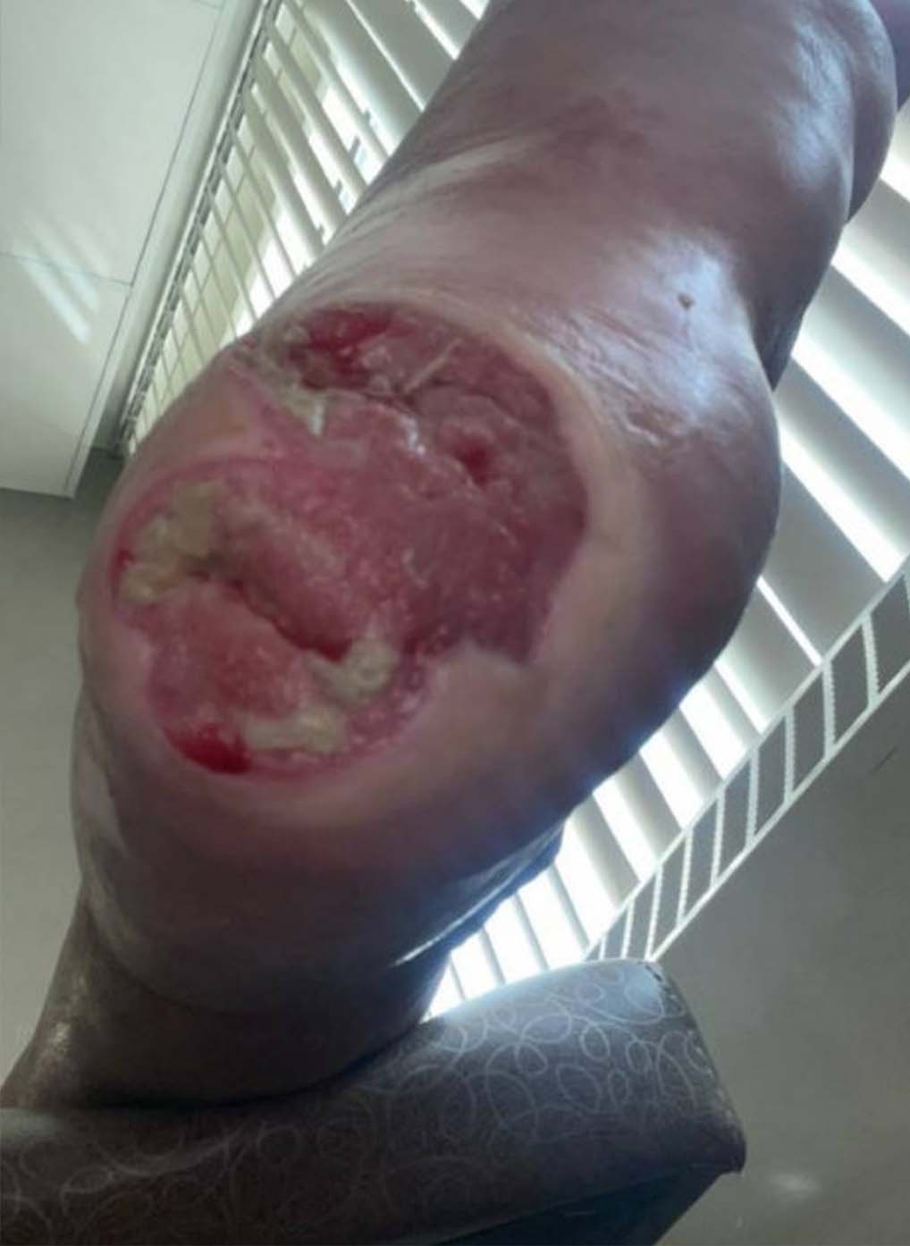 Arterial Wound during UrgoClean Ag treatment-2