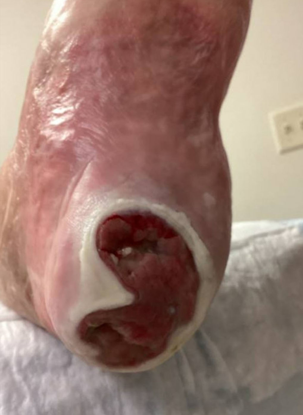 Arterial Wound during UrgoClean Ag treatment-3