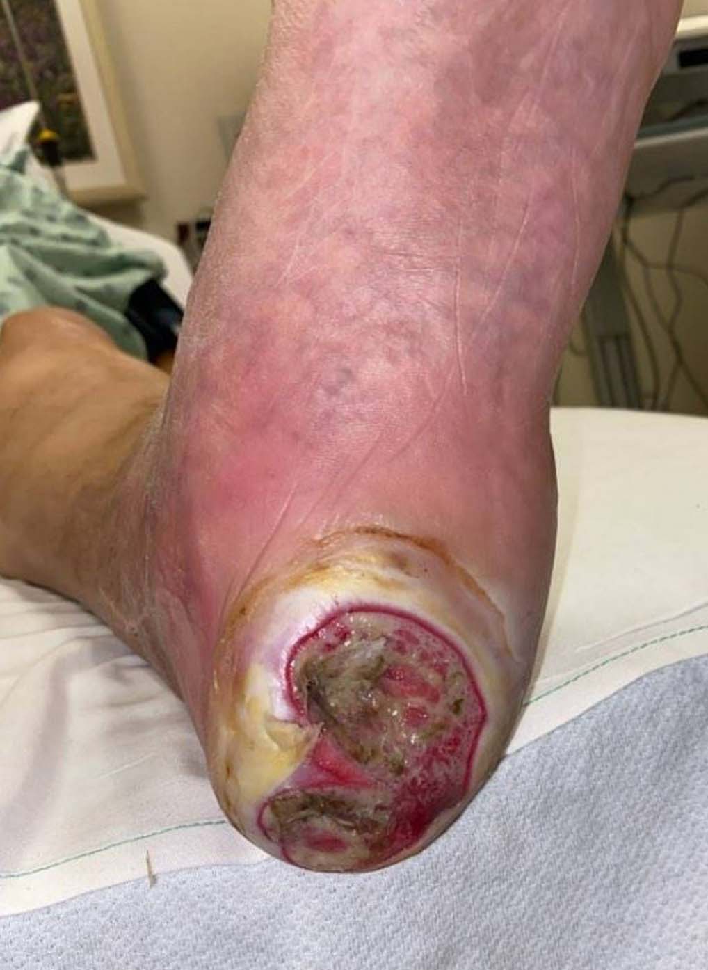 Arterial Wound during UrgoClean Ag treatment-1