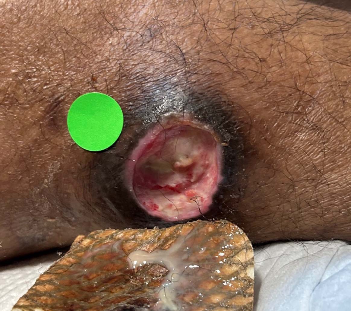 Pressure Injury during UrgoClean Ag treatment-2
