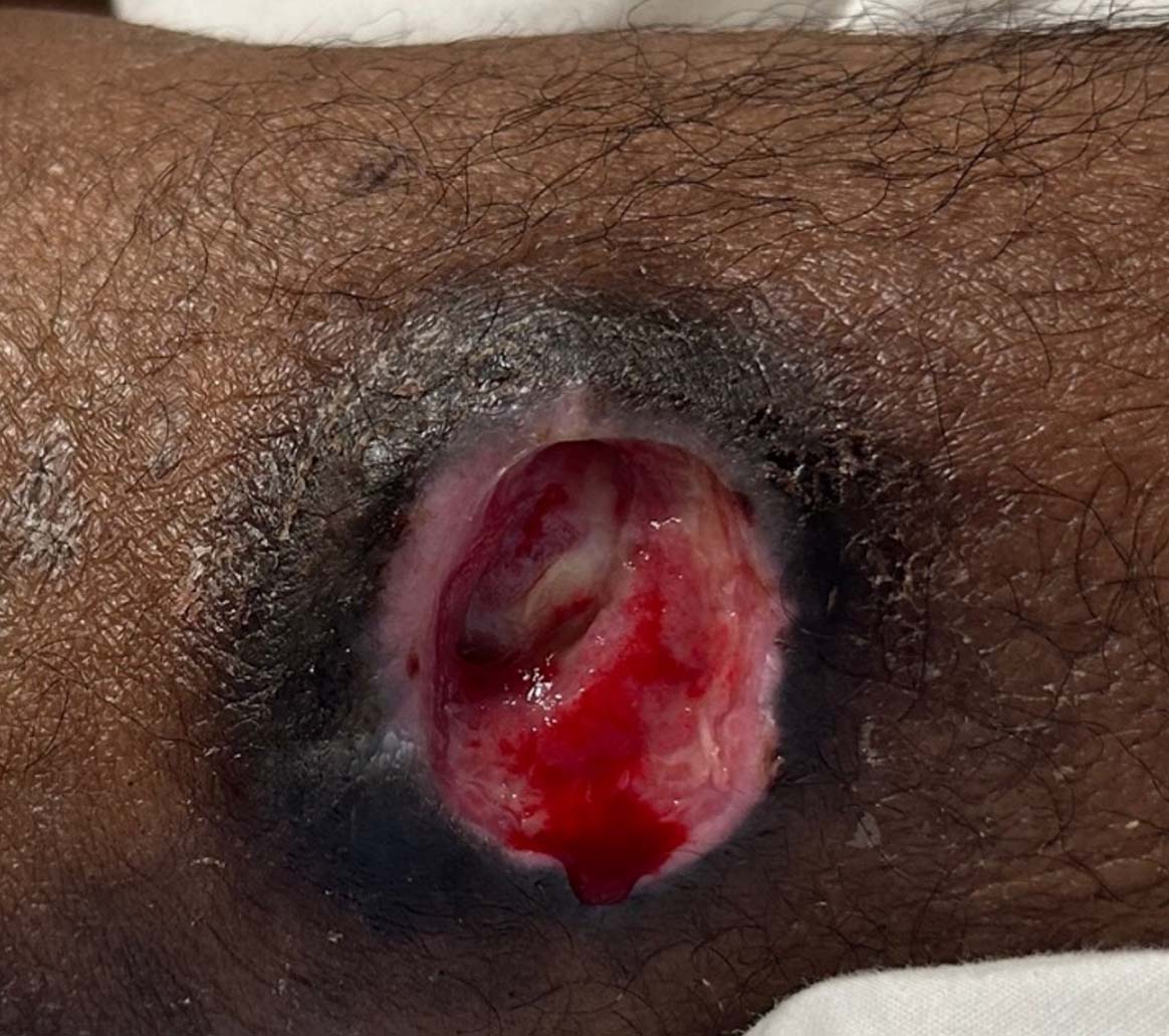 Pressure Injury during UrgoClean Ag treatment-3
