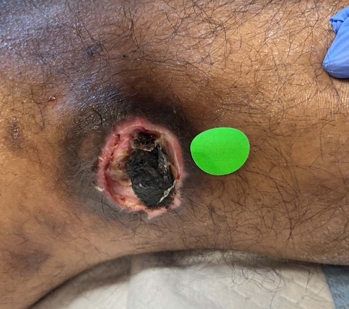Pressure Injury during UrgoClean Ag treatment-1
