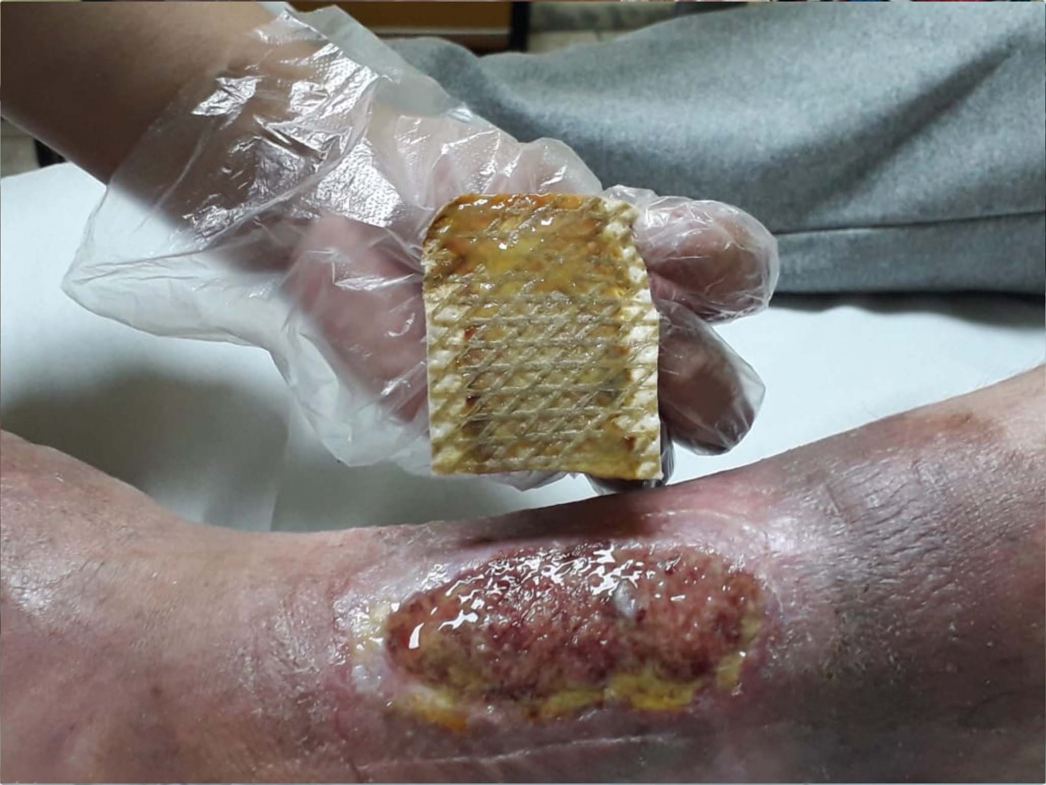 UrgoClean Ag dressing removal 2