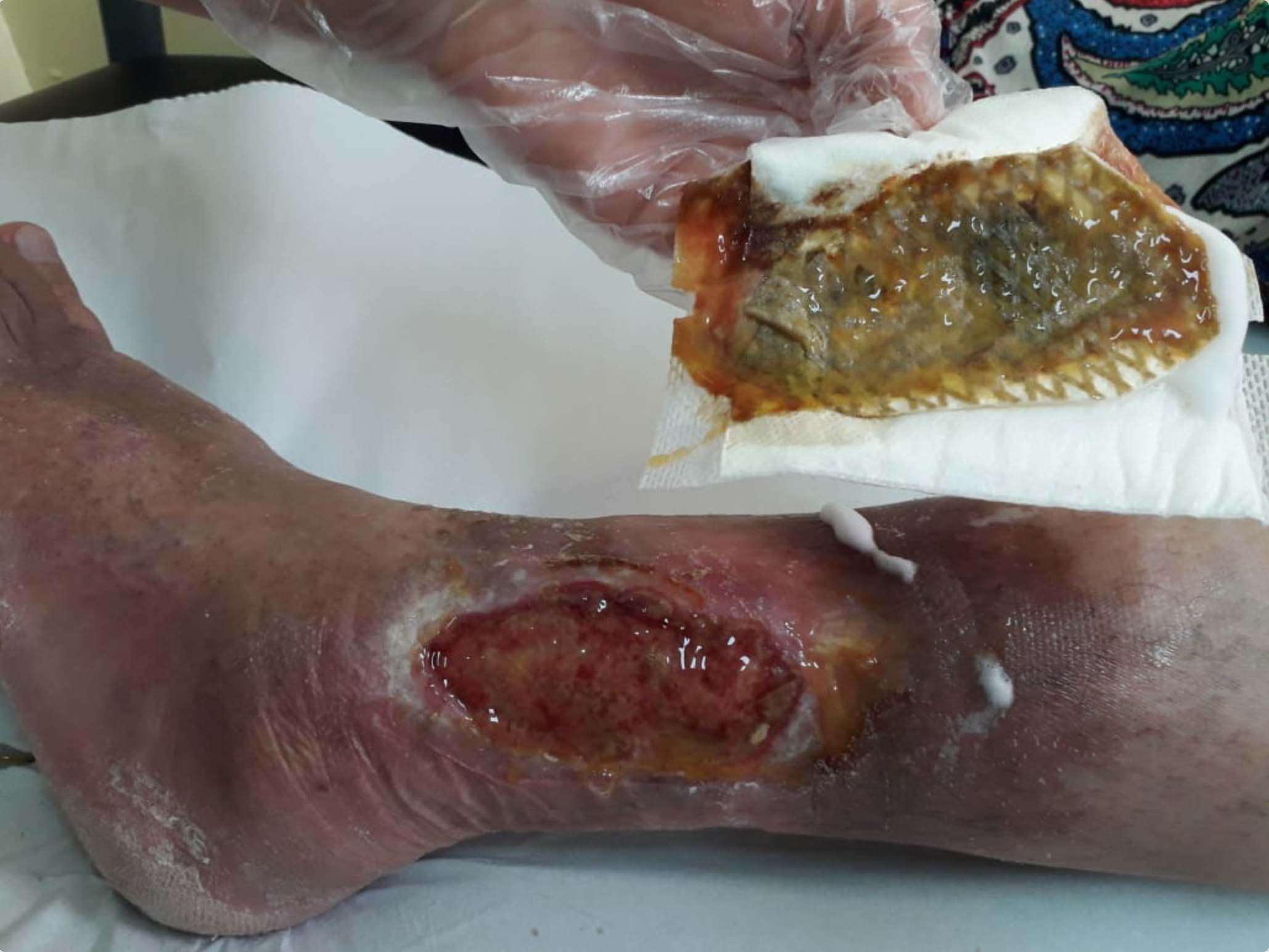 UrgoClean Ag dressing removal 1