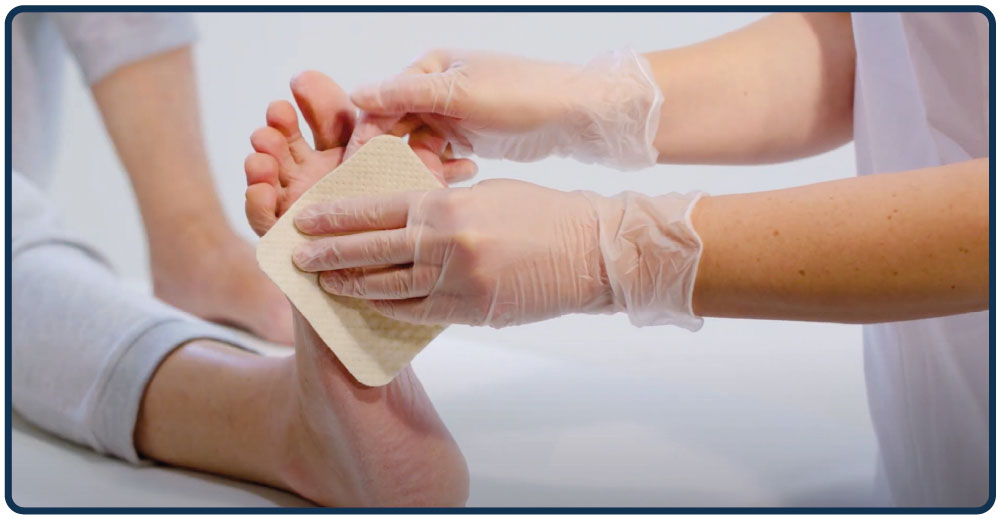 Applying UrgoClean Ag to a wound