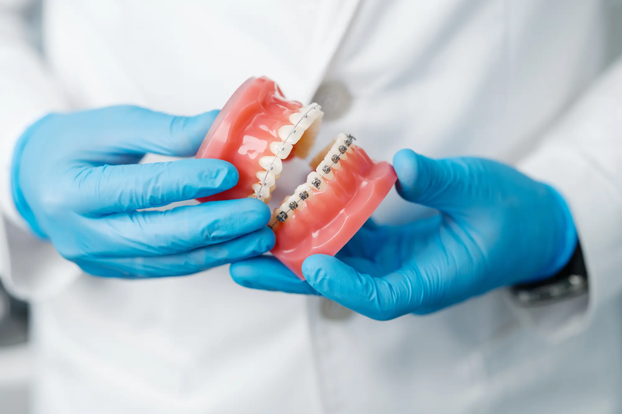 How Do Dentists Fix Gaps in Front Teeth?