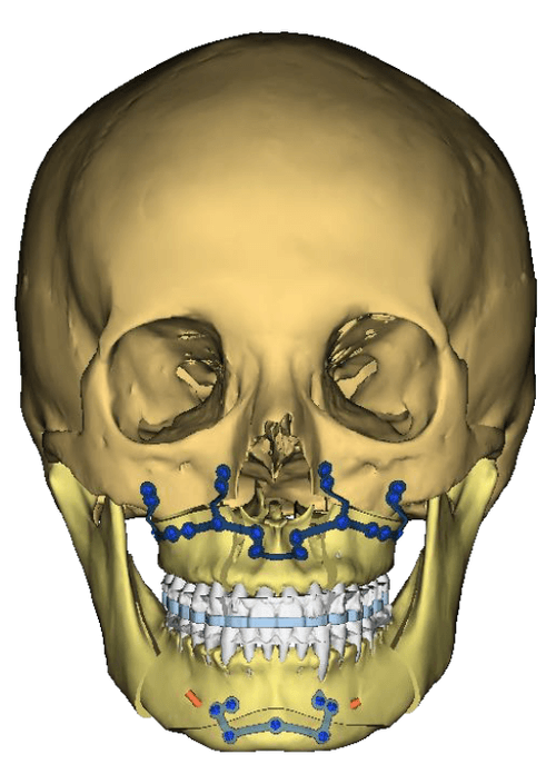 Image chirurgie orthognathique