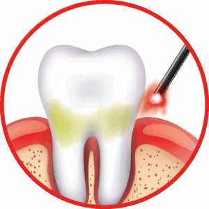 LANAP® Laser Surgery