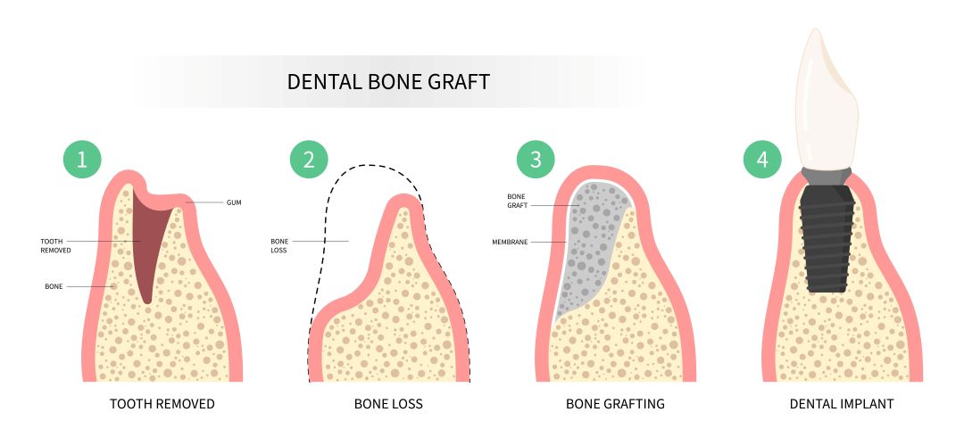 Bone loss after tooth removal