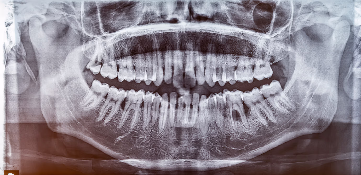 Bone Loss Around Teeth: Causes, Treatment & Can It Grow Back?