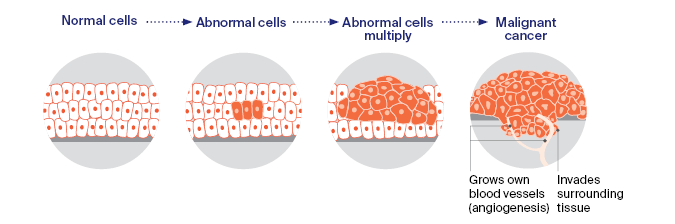 Sequence of images starting from normal cells, and leading to abnormal cells, abnormal cells multiplying, and the development of a malignant cancer which has grown its own blood vessels and invaded surrounding tissue. 