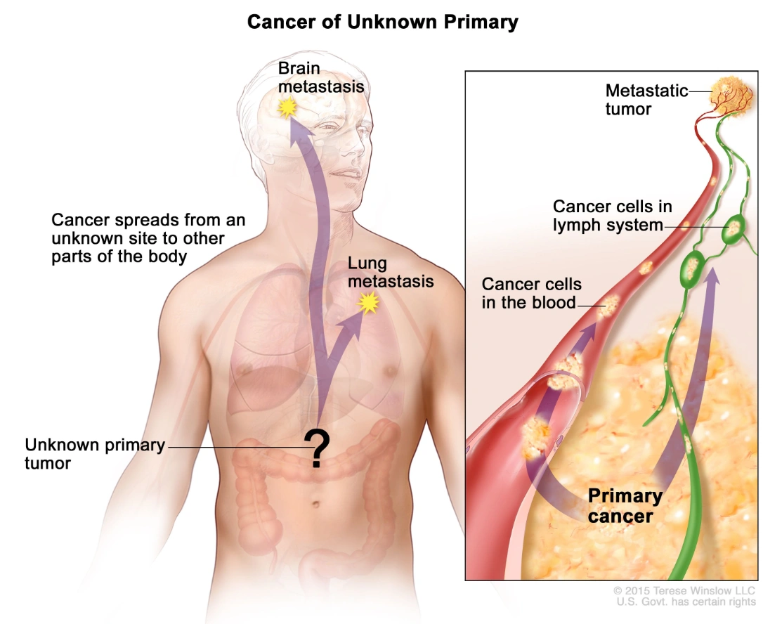 A diagram of how cancer of unknown primary affects the human body. An unknown primary tumour is marked with a question mark over the human body, and arrows point to areas where cancer cells have been found. A secondary image depicts the flow of cancer cells from the primary cancer site through the blood stream or lymphatic system.